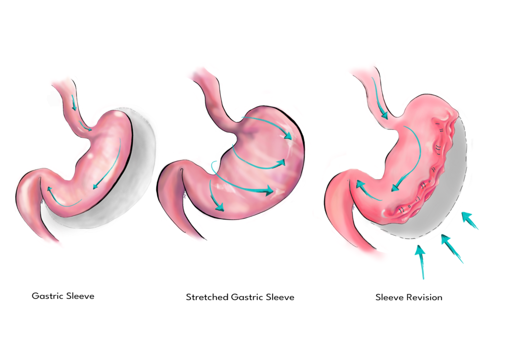 Gastric Sleeve Revision Service 4ward Wellness